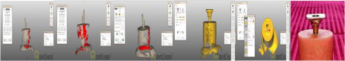 Fig. 3. 3D scanning for abutment and designing for metal tube