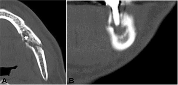 Fig. 3. CT images of the left mandible. a Axial view at the left first molar. b Coronal view at the left first molar