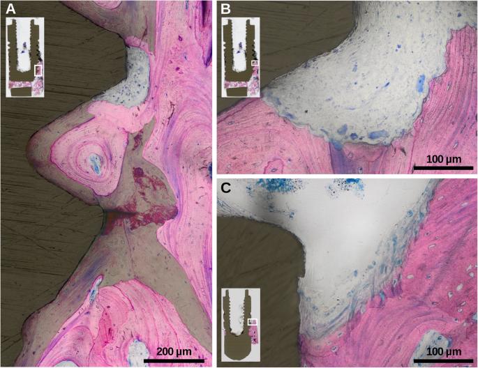 Fig. 3. Histological magnifications of specimens exposing a significant areas of lamellar bone in-between and parallel to the surface of older trabeculae (accentuated by green overlay), b osteoclastic activity, and c active bone formation at intrabony marginal regions