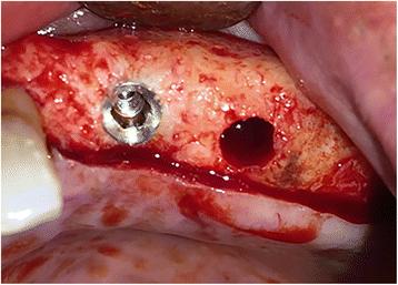 Fig. 3. Implants were placed after application of CGF membrane