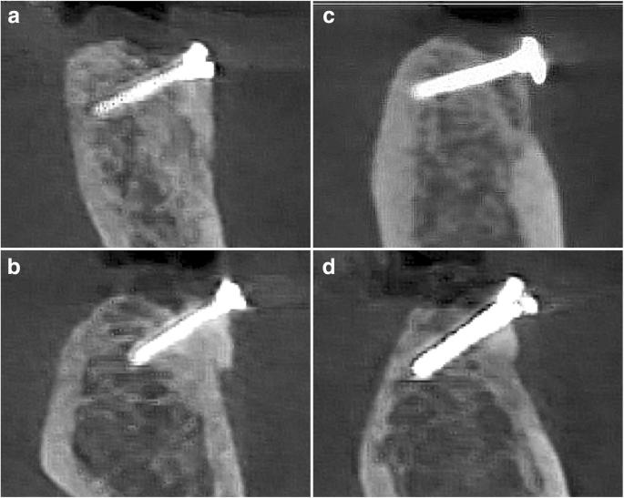 Fig. 3. Representative CBCT outcomes at 26 weeks. a, b TR graft. c, d AB graft
