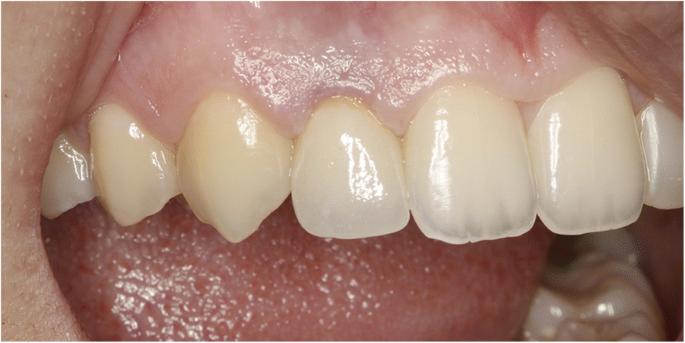 Fig. 3. Vestibular view of right lateral implant supported crown