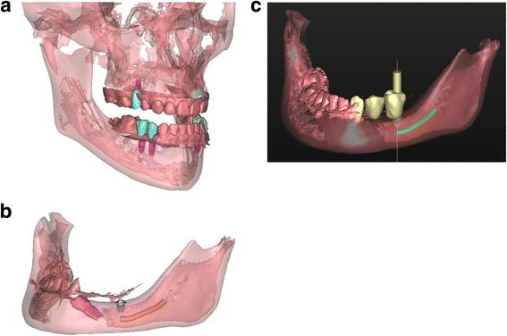 Fig. 4. goal. b Patient 2—virtual set-up of the ultimate implant position. One short dental implant was planned in region 35, based on the location of the mandibular nerve (orange), the impacted 34 (pink) and the bone quality and volume. c Patient 2—virtual set-up of the ultimate prosthetic treatment goal