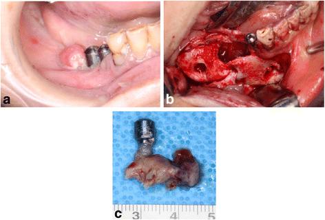 Fig. 4. estrectomy. c Removal of the dental implant with a specimen of the necrotic bone