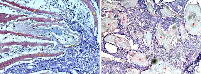 Fig. 4. Photomicrographs of ground sections. a) Treated site. Bone residues (examples in yellow asterisks) included in soft tissue containing fibroblast-like cells and inflammatory cells. b) Untreated site. Xenograft residues (examples in red asterisks) surrounded by soft tissue rich in fibroblast-like cells. Scarlet-acid fuchsine and toluidine blue stain. a) 200 x magnification.; b) 100 x magnification