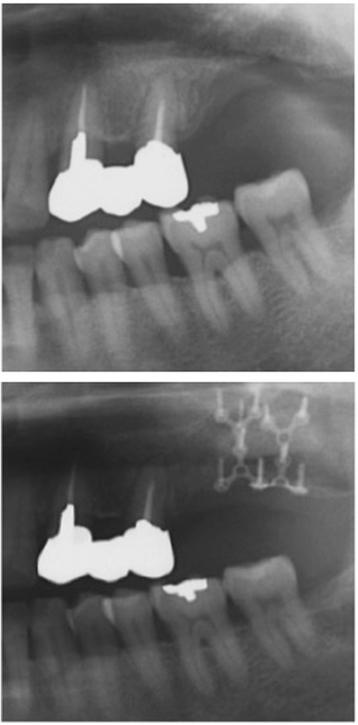 Fig. 4. Preoperative and postoperative radiograph