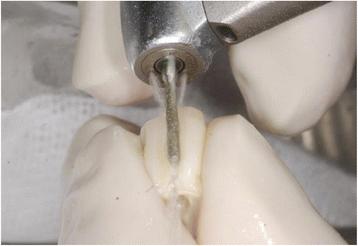 Fig. 4. Removal of enamel and the cementum