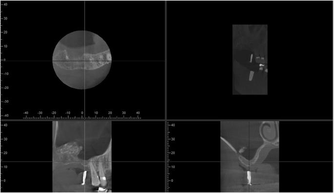 Fig. 4. Right sinus about 12 months after first grafting procedure. Cone beam CT imaging shows little suitable bone at implant site, but grafted bone displaced distal to site. Bone hydroxyapatite particles were added as radiographic marker to the graft material for the first sinus augmentation procedure and are still visible as radiopaque specks