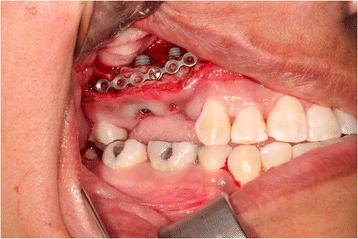 Fig. 4. Vertical repositioning of dental alveolus segment with placement of dental implants