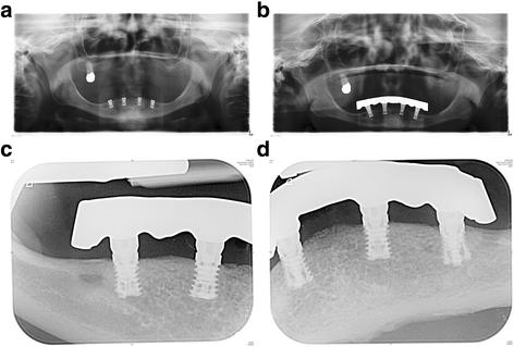 Fig. 5. a Postoperative orthopantomogram. b Follow-up orthopantomogram. c Follow-up standard periapical radiogram (implants i42 and i44). d Follow-up standard periapical radiogram (implants i32 and i34)