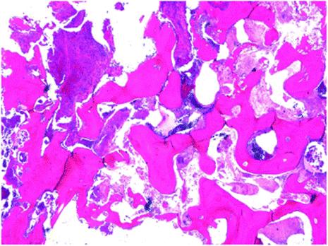 Fig. 5. Histopathologic photo of the resected mandible (H-E staining)