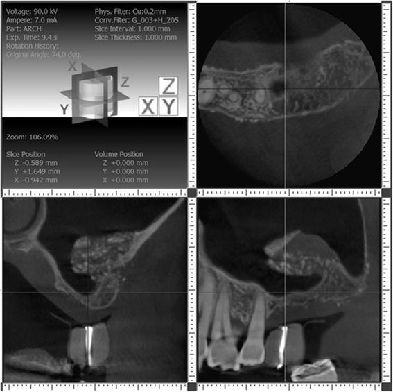 Fig. 5. Left sinus about 12 months after first grafting procedure. Cone beam CT imaging shows unusual sinus anatomy after grafting, with finger-like sinus extension at implant site, and thick-grafted bone buccal and apical to it. The infractured wall is still clearly visible, as well as the bovine bone particles used as radiographic marker