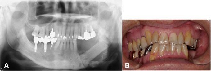 Fig. 6. a Panoramic X-ray image 1 year after the surgery. b Intraoral photo 1 year after the surgery