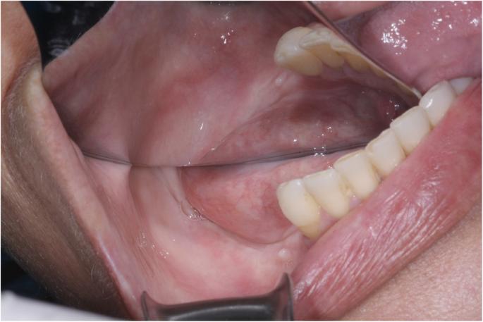 Fig. 6. Image obtained 7 months postoperatively showing no lesions