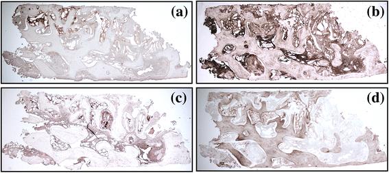 Fig. 6 Immunohistochemical analysis of slices from the same sample with four different markers. a TRAP. b OPN. c ALP. d OSC