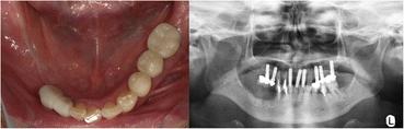 Fig. 6. Postoperative intraoral finding and radiograph
