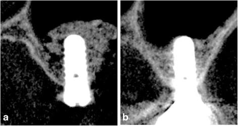 Fig. 6. Radiographic examination: The relationship between changes in the maxillary sinus floor associated with a reduction in the grafted bone and the implant tip (a immediately after surgery, b 5 years after surgery)