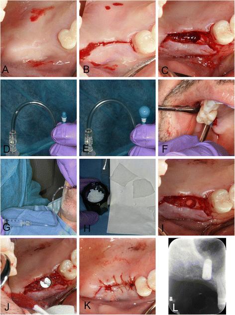 Fig. 6. Right sinus balloon dilation procedure. This photographic series shows the surgical procedure that augmented bone and allowed implant placement at the no. 3 site. a Preoperative view after infiltration anesthesia. b Full-thickness midcrestal incision. c Osteotomy preparation with implant drills and osteotomes. d, e The dilating balloon, which is inflated using saline pressure from a syringe. f Insertion of uninflated balloon into osteotomy. g Gentle inflation of balloon by 1 ml. h Preparation of allograft and collagen tape. i Collagen tape is visible at bottom of osteotomy after filling expanded Schneiderian membrane with bone graft and covering graft with collagen tape. j Implant placement. k Suturing with a continuous suture. l Postoperative radiograph showing implant and halo of allograft surrounding apex of implant after surgery