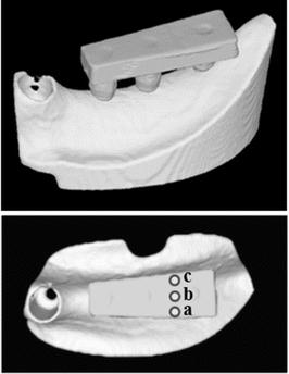 Fig. 7. A finite element analysis (FEA) model. (a) Buccal load, (b) central load, and (c) lingual load