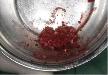 Fig. 7. Autologous, particulated dentin mixed with blood from the operating site
