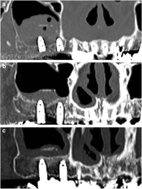 Fig. 7. Radiographic findings on panoramic computed tomography after nongrafted sinus lift with simultaneous implant placement. a Immediately. b At 6 months. c At 42 months