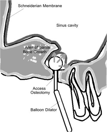 Fig. 7. Schematic diagram of sinus balloon dilating procedure. This diagram shows how the balloon is inserted into a small transcrestal osteotomy and then expanded with balloon