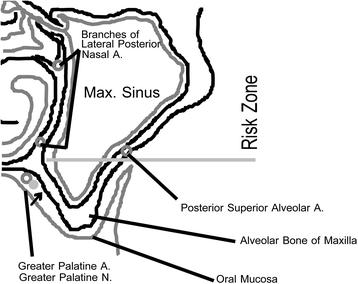 Fig. 8. Blood supply of the sinus. There are three areas in the sinus where blood vessels may be encountered during sinus augmentation procedures for implants. On the inflection point between hard palate and alveolar ridge in the posterior maxilla, the greater palatine neurovascular bundle is located embedded in soft tissue. This inflection point is matched in the internal sinus anatomy and presents a landmark that can be palpated with sinus curettes during sinus membrane elevation or seen on cone beam CT images in this patient. It is important to avoid instrumenting the area above this inflection point as branches of the lateral posterior nasal arteries may be encountered superior to this area. Injuring these blood vessels can lead to significant sinus bleeding that is difficult to stop without sinus tamponade. Often on cone beam CT images, we see a small blood vessel channel midway within the lateral wall of the sinus, which likely is the posterior superior alveolar artery and vein. This and the interior medial wall sinus inflection point can serve as anatomic landmark to delineate a risk zone superior to it and to limit sinus augmentation inferior to it