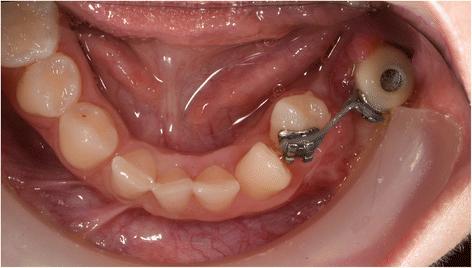 Fig. 8. Patient 2—intra-oral situation during orthodontic treatment at the age of 14. A temporary crown with bracket is fixed on the dental implant. Eight months after start of orthodontic treatment, the 34 is already close to the planned end position