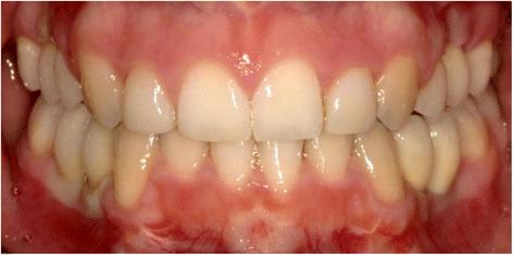 Fig. 9. Patient 1—prosthodontic end result 5 months after implant placement