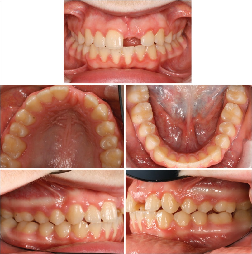 Figure 7: End of treatment photos showing full incisor space, optimum overjet, and overbite