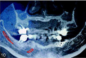 Tomographic images showing severe maxillary resorption to the basal bone between teeth No. 3 and No. 12.