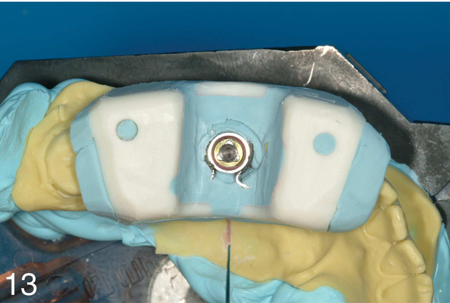 Cast-based surgical guide.