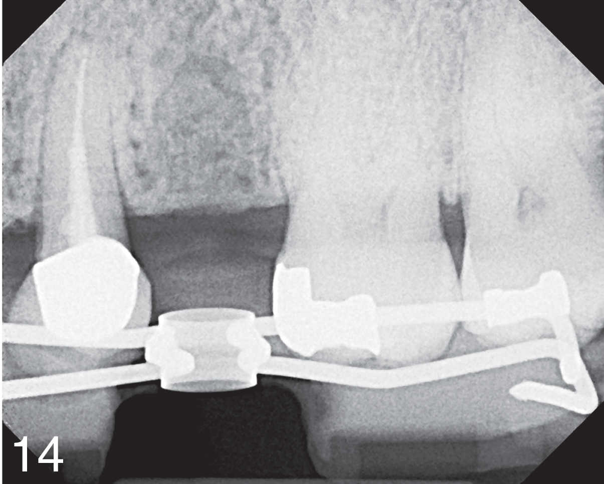 Radiographic view of the cast-based surgical guide.