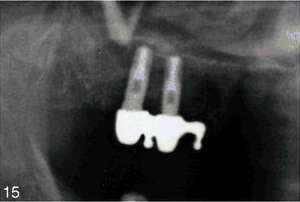 Panoramic radiograph (close view) depicting 2 implants in the right posterior maxilla with the mesobar in place. Two abutment copings and 2 O-ring attachments can be seen: one in-between two copings and one on the mesial end of the mesobar.