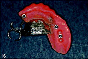 Maxillary partial implant-retained overdenture at the delivery stage with 3 female components of the O-ring system inside the denture and clasps for the existing bridge No. 12-13-14.