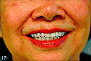 Post-completion photograph of the patient in the case report wearing the maxillary implant overdenture and showing harmonious soft tissue relationship of the lower face.