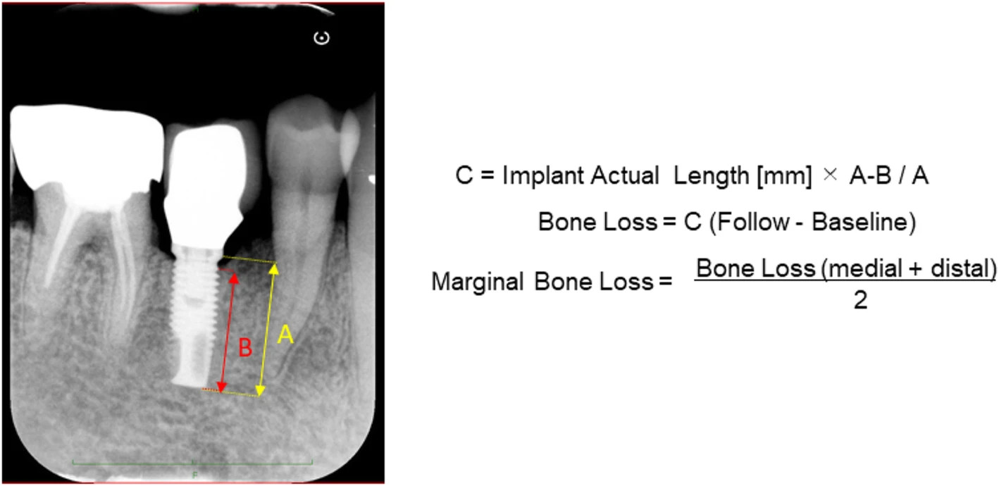 Figure 2. Measurement of marginal bone loss (MBL) on dental radiography. MBL is measured using Image J software (National Institutes of Health, Bethesda, MD, USA). The reference points for the measurements are the implant platform (the horizontal interface between the implant and the abutment), the implant tip, and the first bone-implant contact (FBIC). The length from the implant platform to the FBIC defines the marginal bone level. The marginal bone level is measured in mm using the ratio of the real implant length and the length from the implant platform to the tip on the images