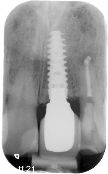 Figure 2. Conventional intra-oral radiograph of same patient with implant-supported restoration at position 21.