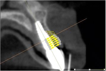 undefinedeasurements.  Measurements  were performed at each millimeter along the axis of the implant for 5 mm, beginning at the neck of the implant.
