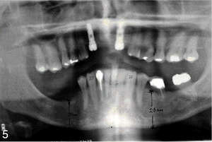 Panoramic radiograph showing the bone remodeling changes of the alveolar process common for CS: resorption of anterior maxilla (treated with 2 endosseous implants) and right posterior mandible. A bone atrophy of the left mandible and a bone hypertrophy of the left maxilla are mild due to preserved teeth in a stable occlusal relationship. A bone atrophy of the right mandible and a bone hypertrophy of the right maxilla (with teeth extrusion) are pronounced due to lack of mandibular posterior teeth and posterior occlusion (occlusal pairing). Measurements of the mandibular body height from the alveolar crest to the inferior border of the mandible on equal distances from the midline at the first molar position: 26 mm (taken as 100%) on the left and 20 mm (relative 20% bone height reduction) on the right due to CS-associated atrophic changes. The patient has been wearing upper and lower removable partial dentures for the past 25 years. CS classification: Class II, Mod. 3 (II-3).