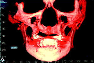 Tomographic images showing severe maxillary resorption to the basal bone between teeth No. 3 and No. 12.