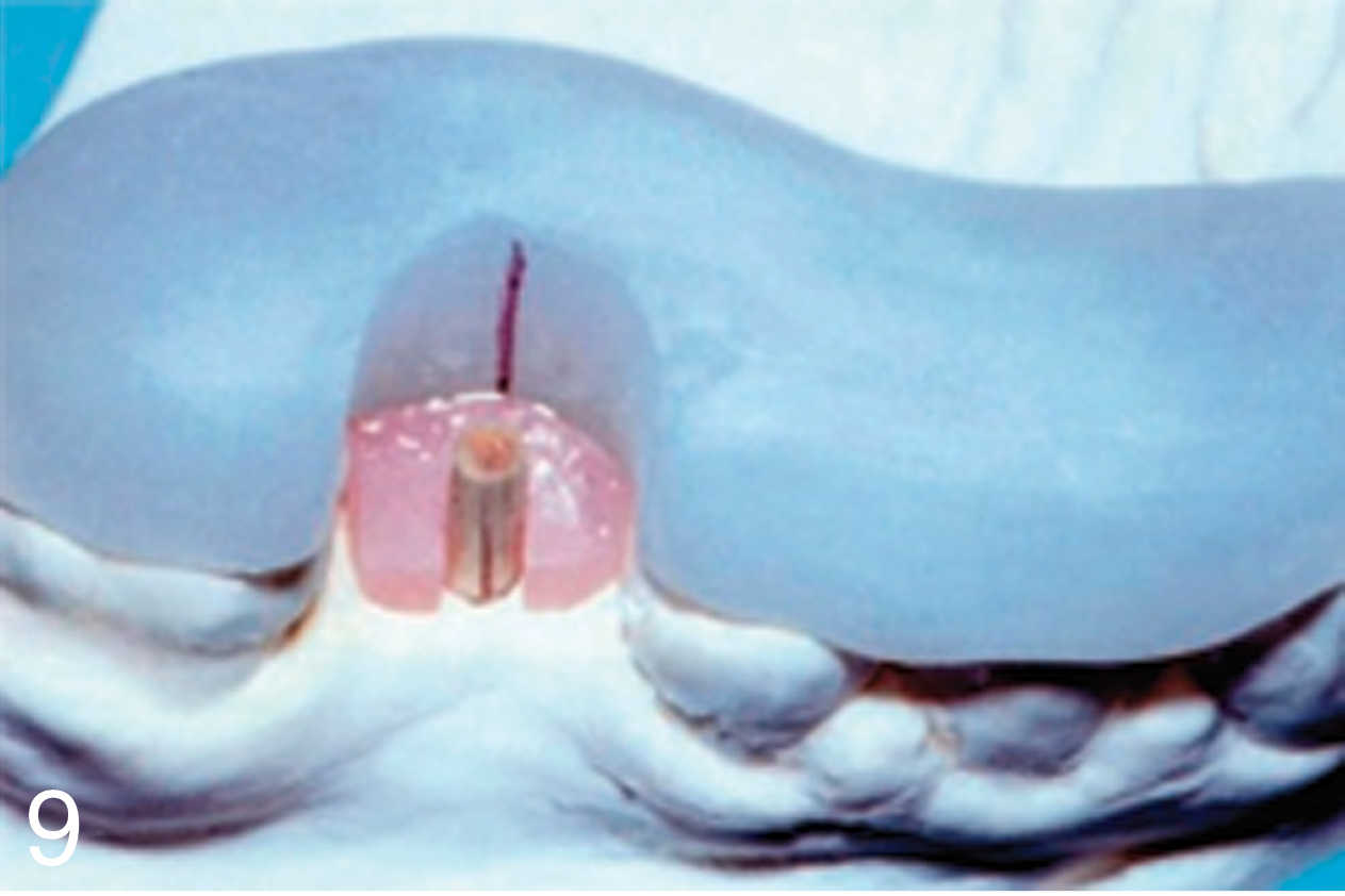 Two-piece implant placement surgical guide.