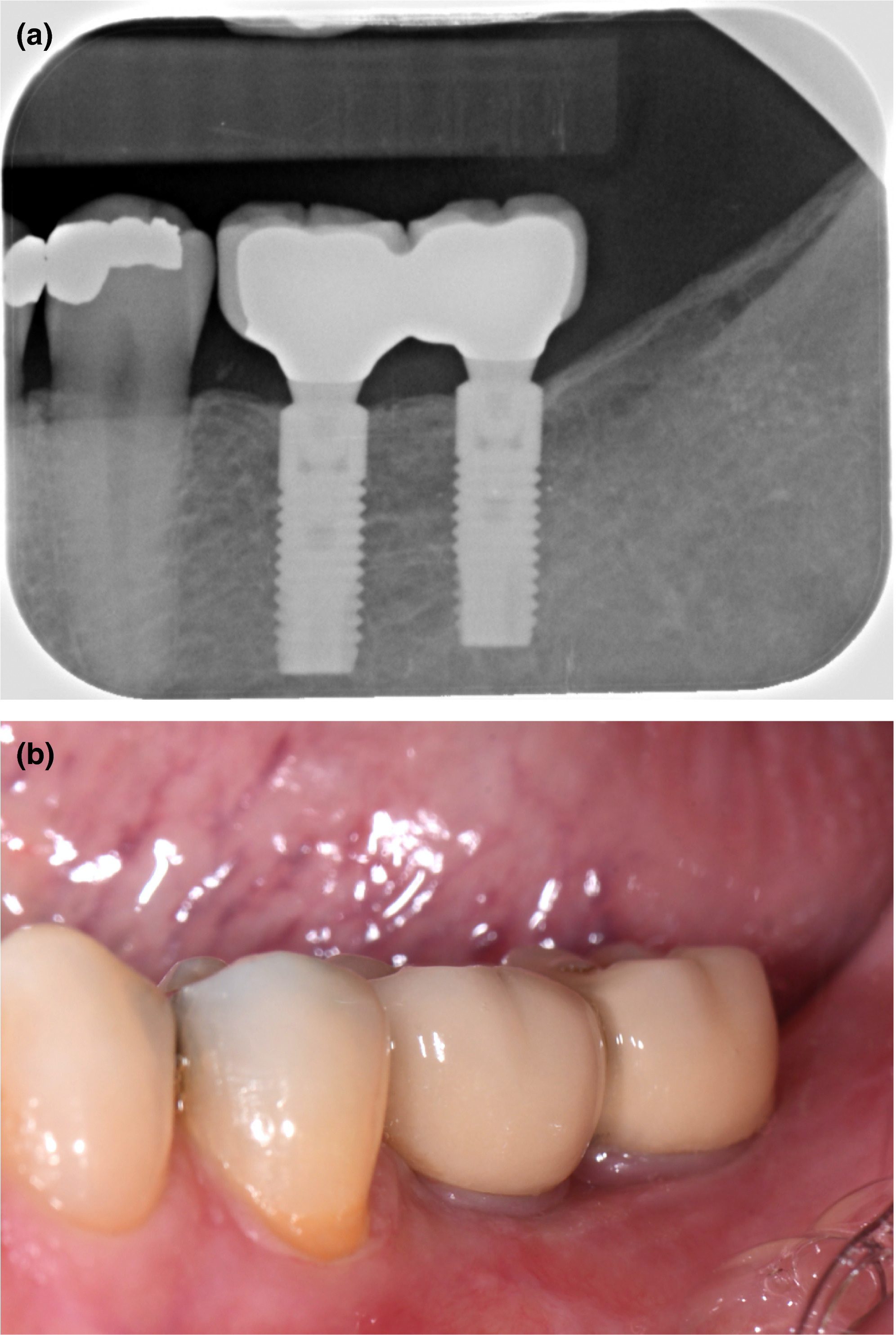 Figure 2. Five‐year follow‐up radiograph (a) and clinical photograph (b) of patient with two 11‐mm implants