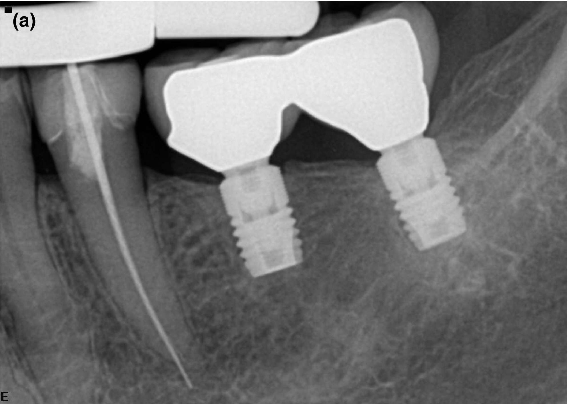 Figure 1a. Five‐year follow‐up radiograph of patient with two 6‐mm implants