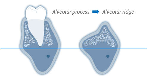 forming alveolar ridge