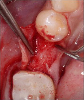 Illustration 2. Crestal incision and preparation of a split-flap