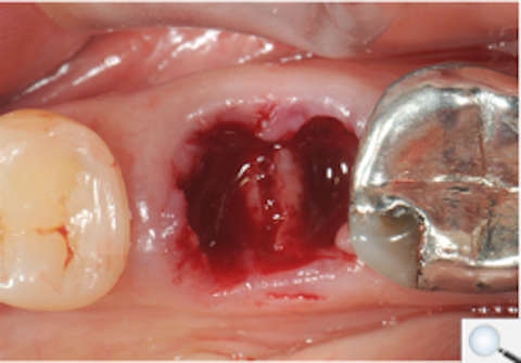 Mandibular molar extraction