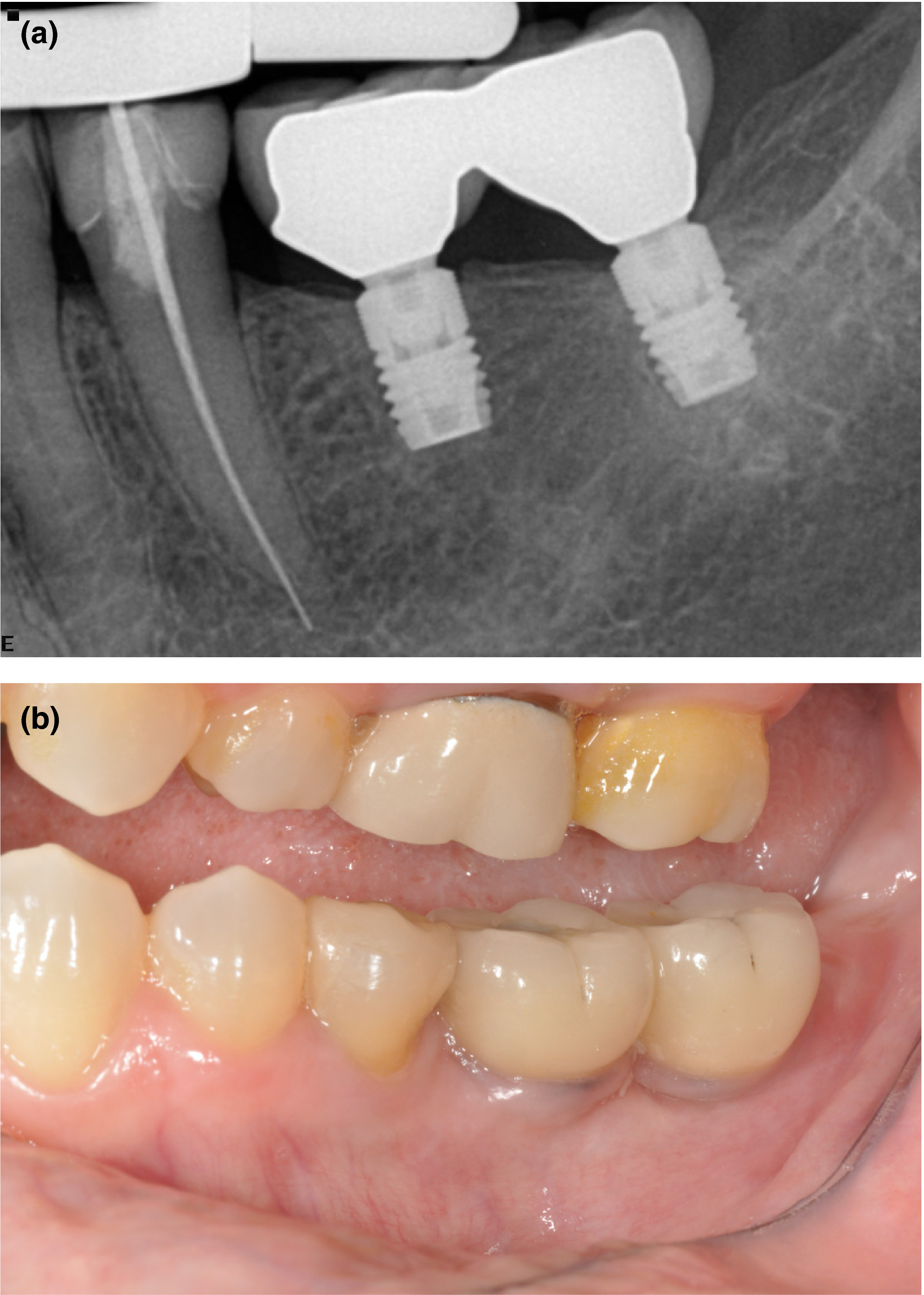 Figure 1. Five‐year follow‐up radiograph (a) and clinical photograph (b) of patient with two 6‐mm implants