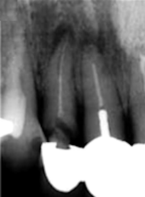 Periapical lessions