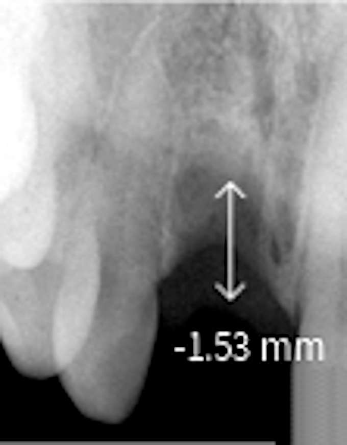 radiographic height reduction